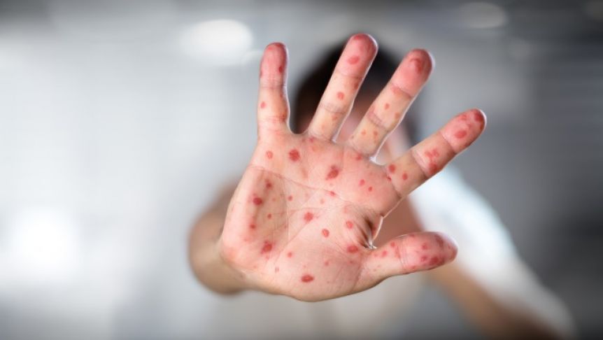 Viruela de mono: cuáles son las recomendaciones para prevenir el contagio
